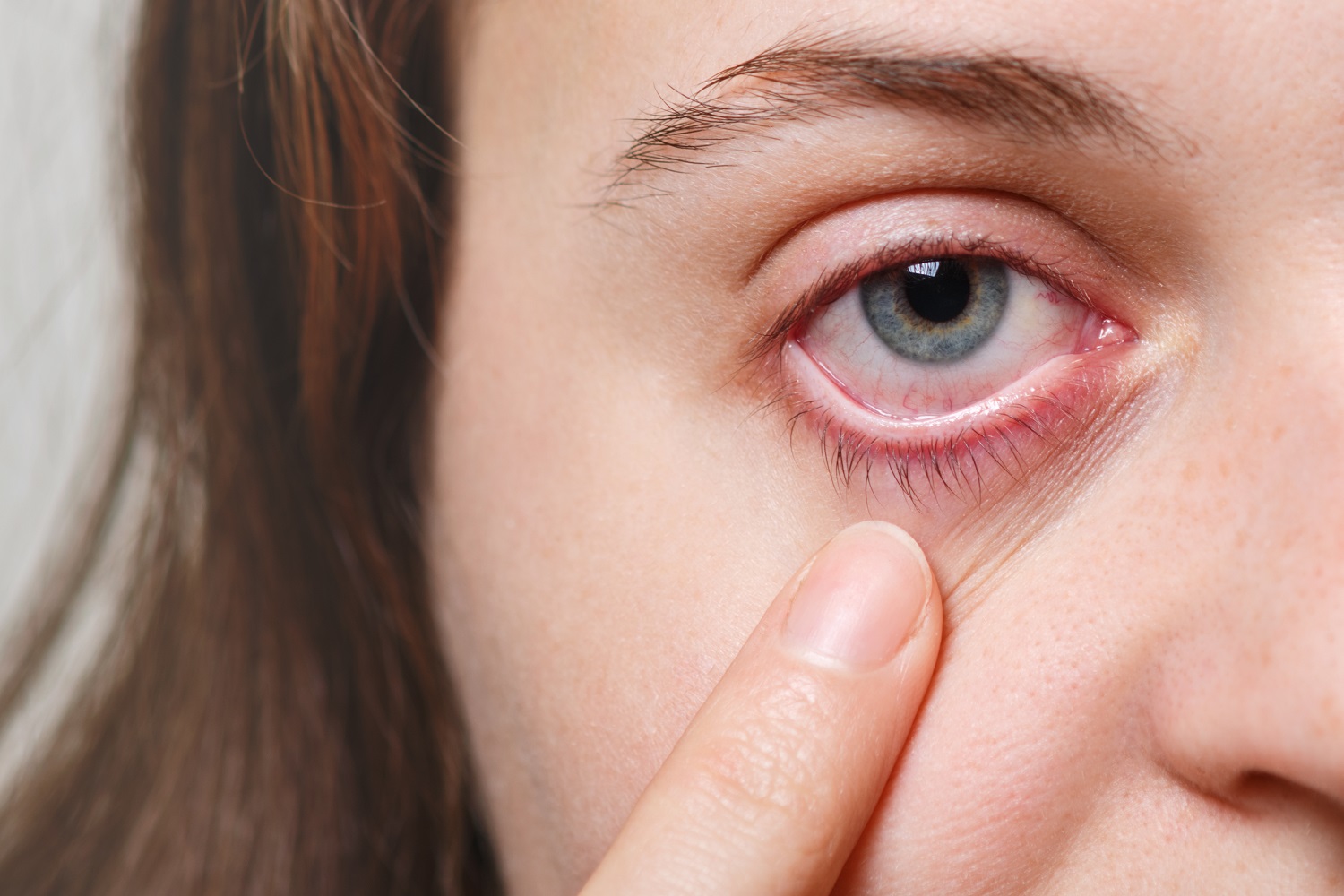 नेत्र फ्लू-Eye Flu-conjunctivitis